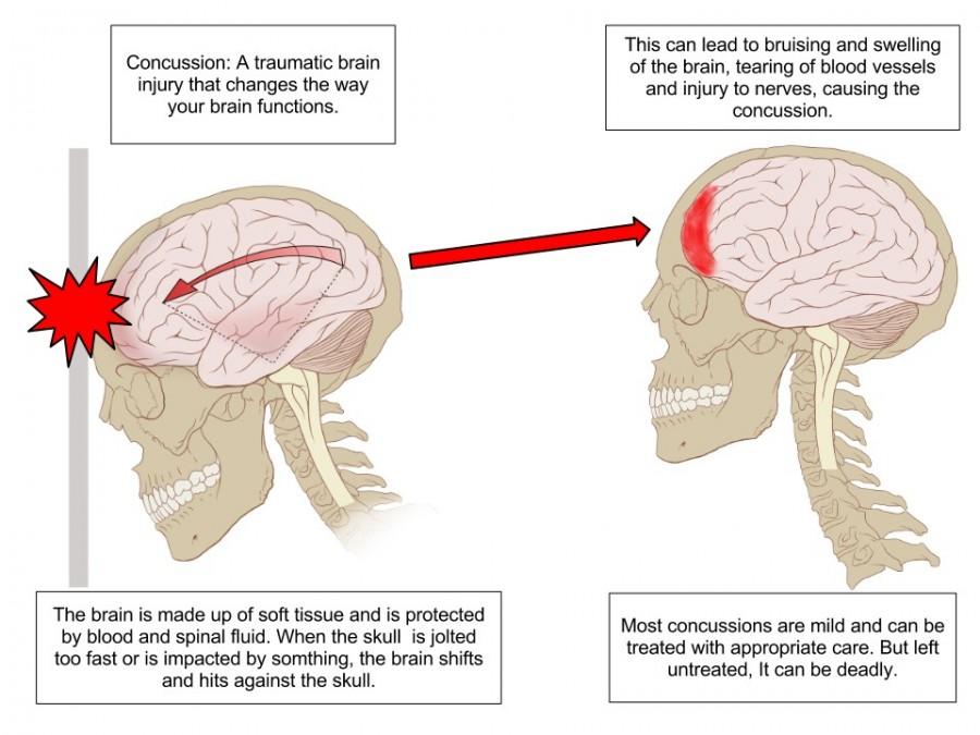 Head injuries raise awareness about concussion protocol